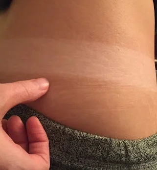 Tan lines on my hip (a few hours after tan application)