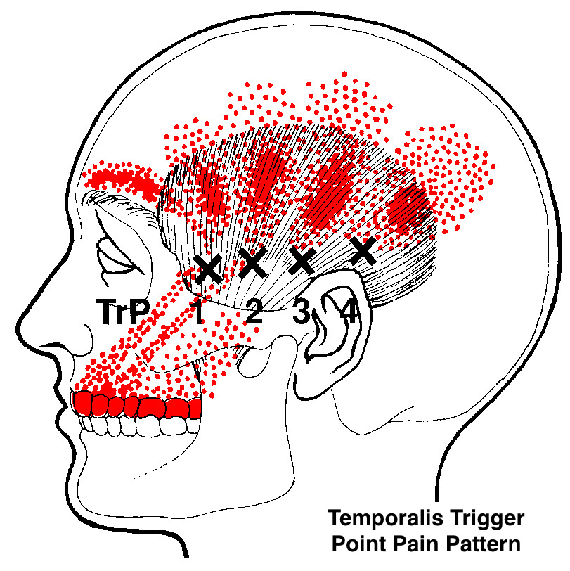 Tmj Chart