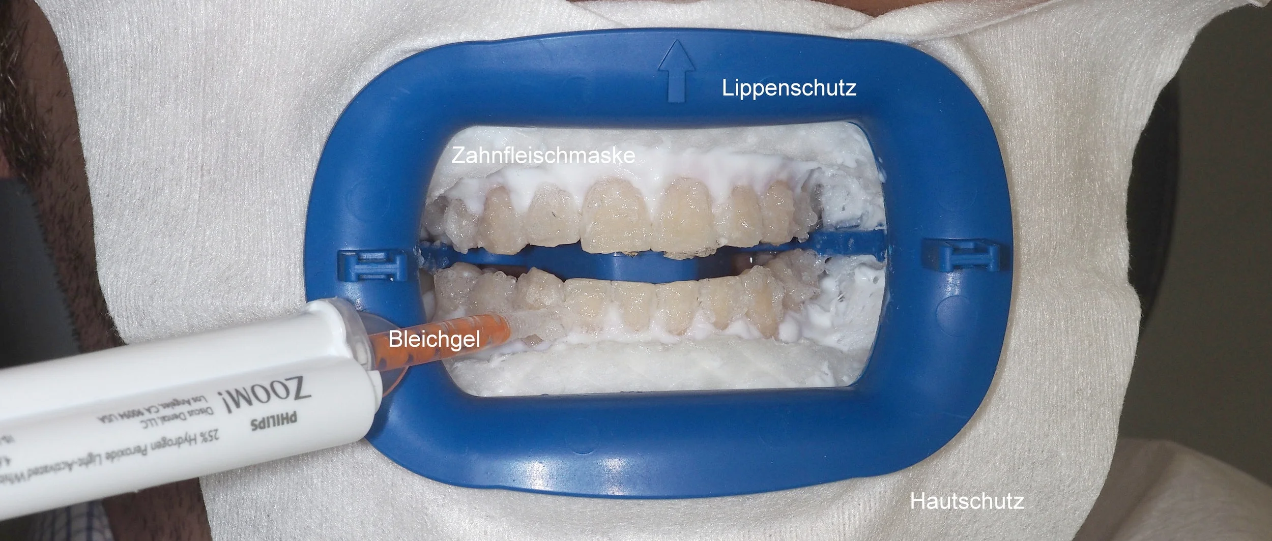 Schutzmaßnahmen für Zahnfleisch und Lippen: Gel-Schutzfilm und Lippen-Gummischutz. 