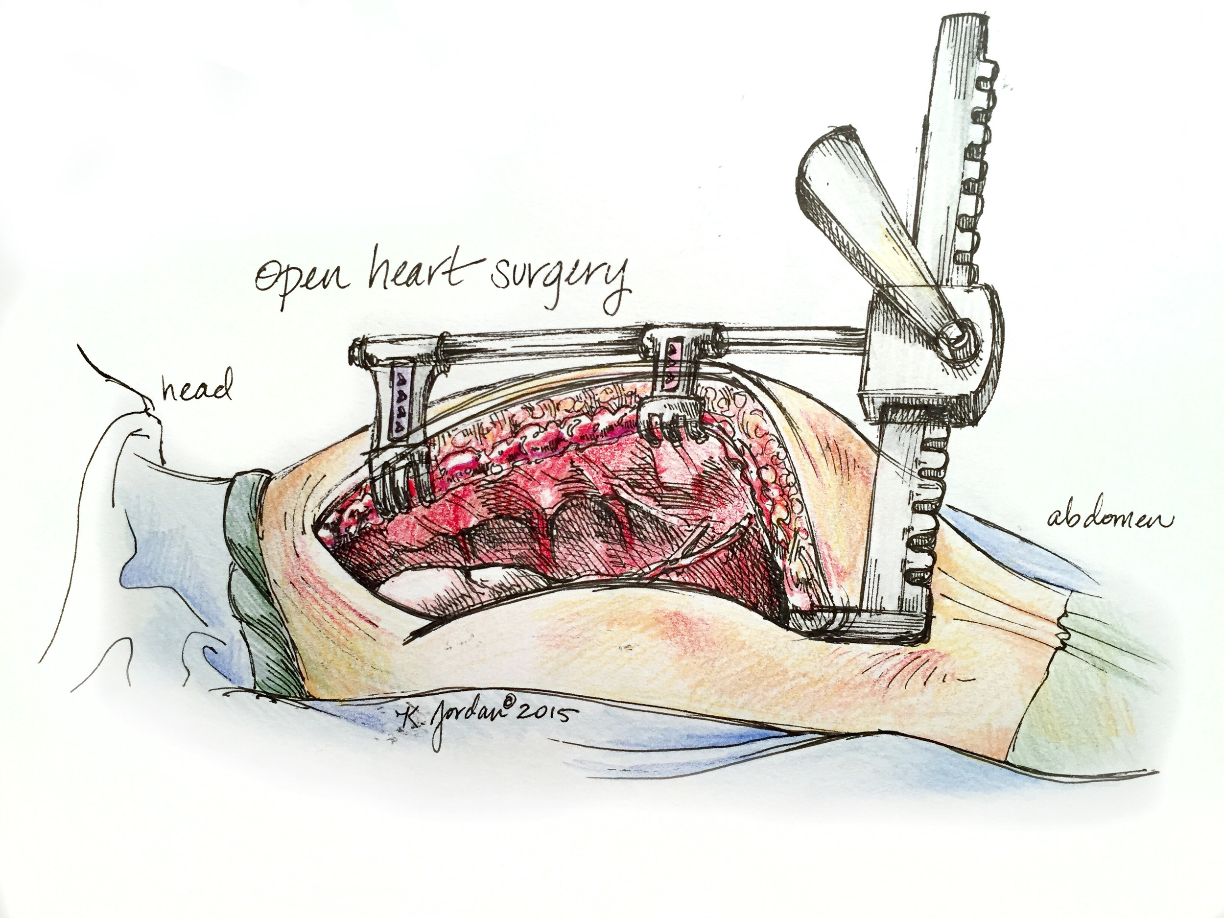 Surgical Sketch: Open Heart