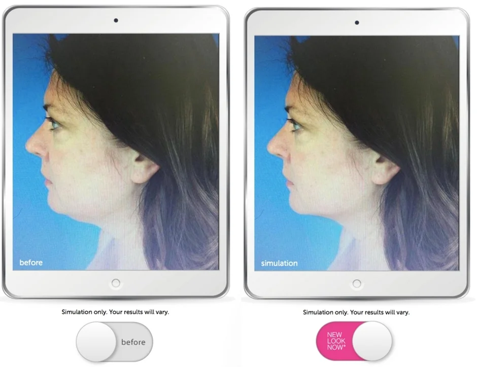 My actual before and simulated after. Visualizers powered by New Look Now