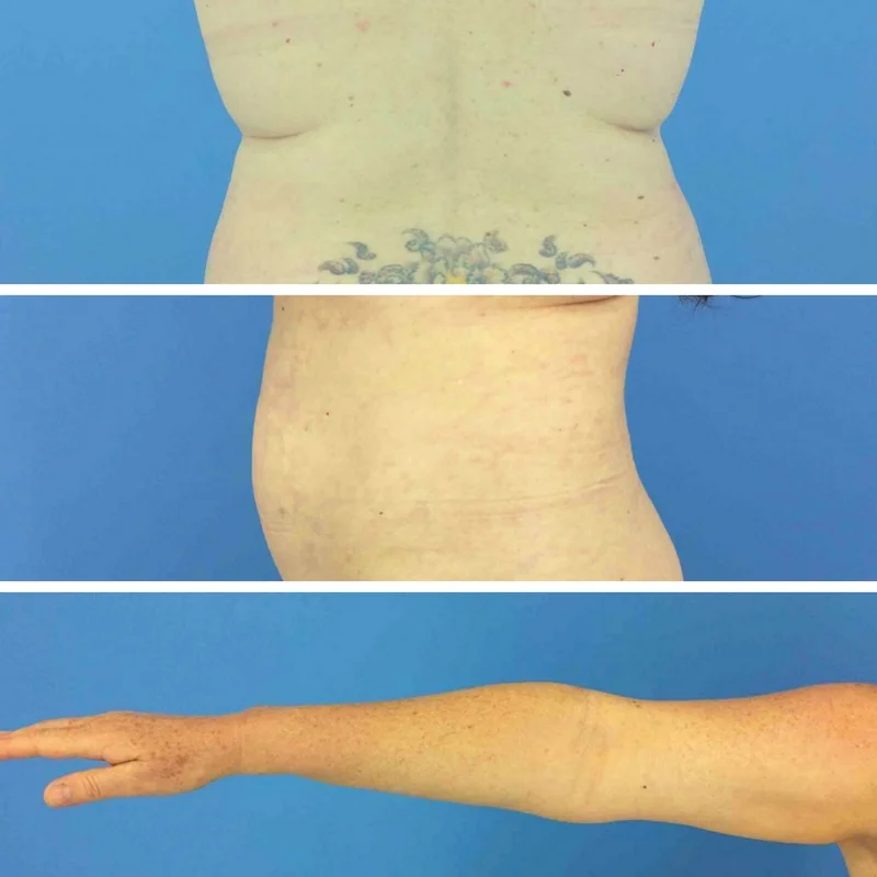 Before pictures of back, arm and stomach 