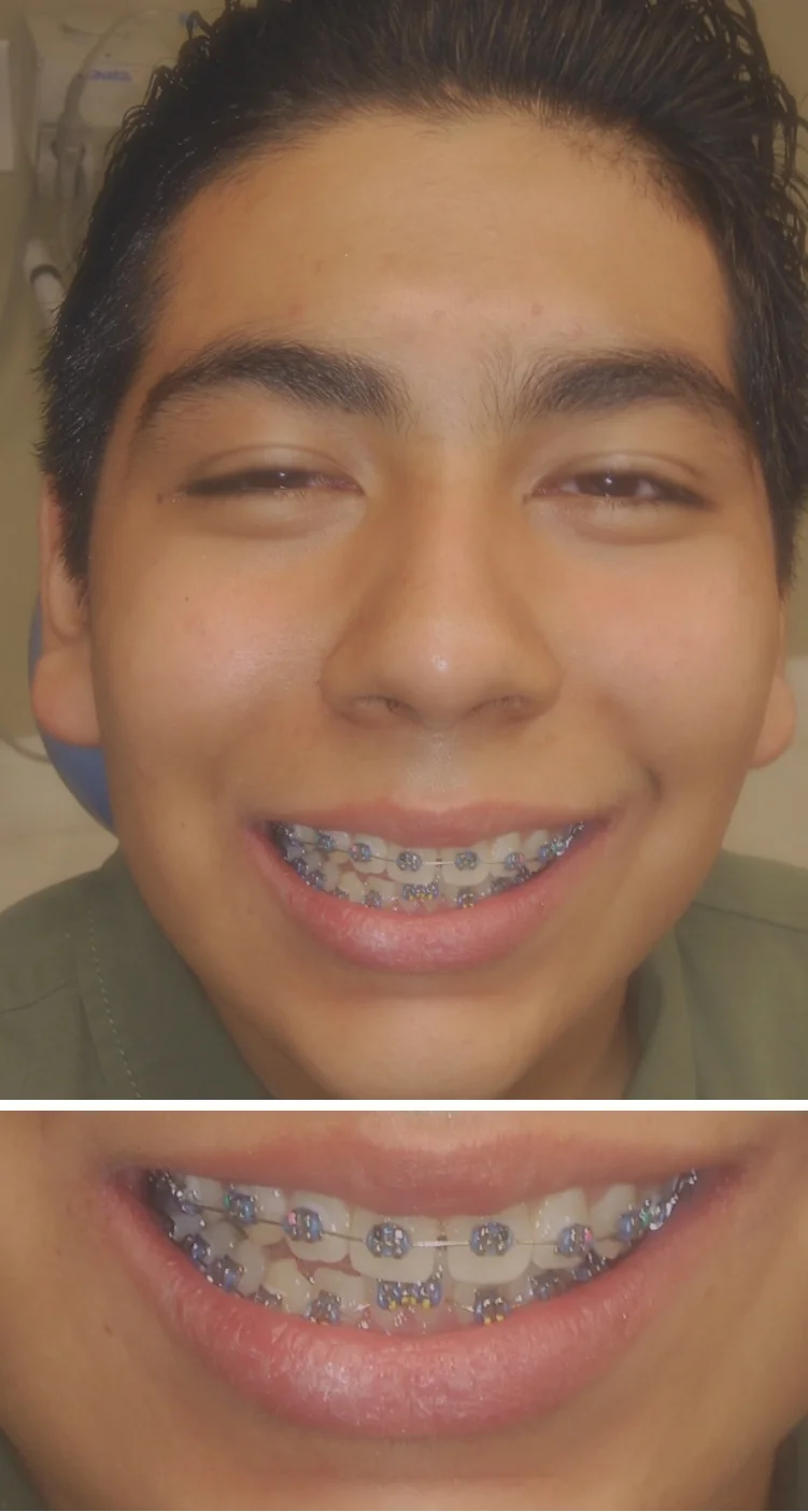 Clinica Dental Dentistas En Tijuana Mexico Dentist In Tijuana Centro Implantes Dentales Dental Implants Coronas Crowns Dentaduras Dentures Braces Brackets Extractions Deep Cleaning And Root Canal Therapy