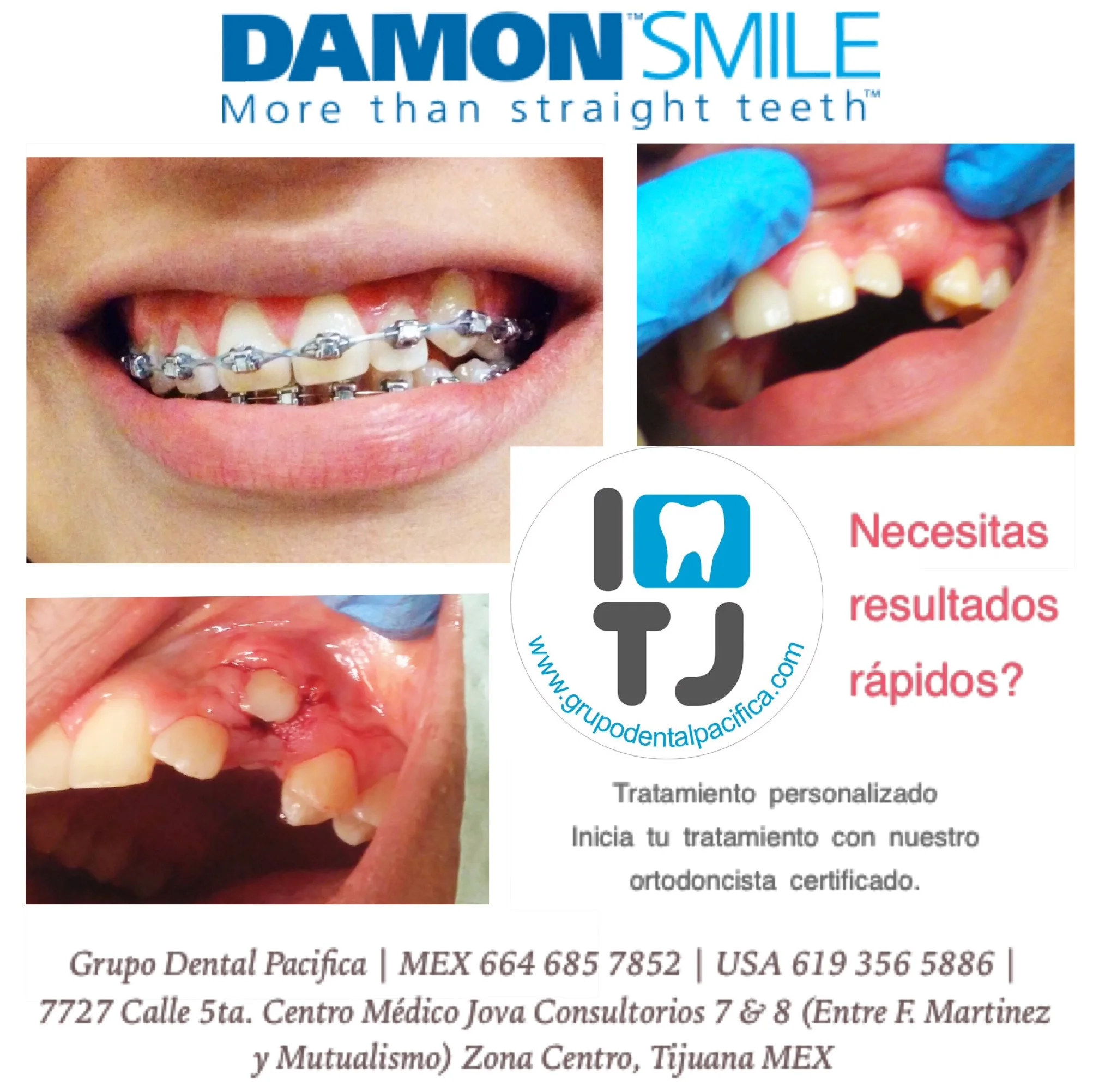 Clinica Dental Dentistas En Tijuana Mexico Dentist In Tijuana Centro Implantes Dentales Dental Implants Coronas Crowns Dentaduras Dentures Braces Brackets Extractions Deep Cleaning And Root Canal Therapy