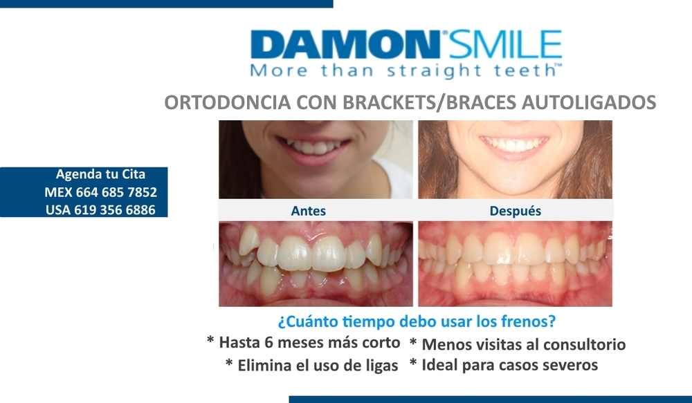 Brackets+Dentista+en+Tijuana+Grupo+Dental+Pacifica.jpg