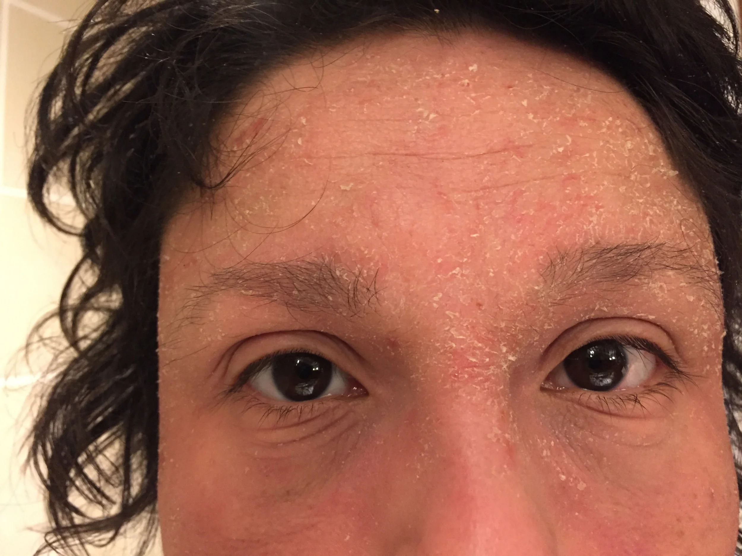 eczema_during_pregnancy.jpg