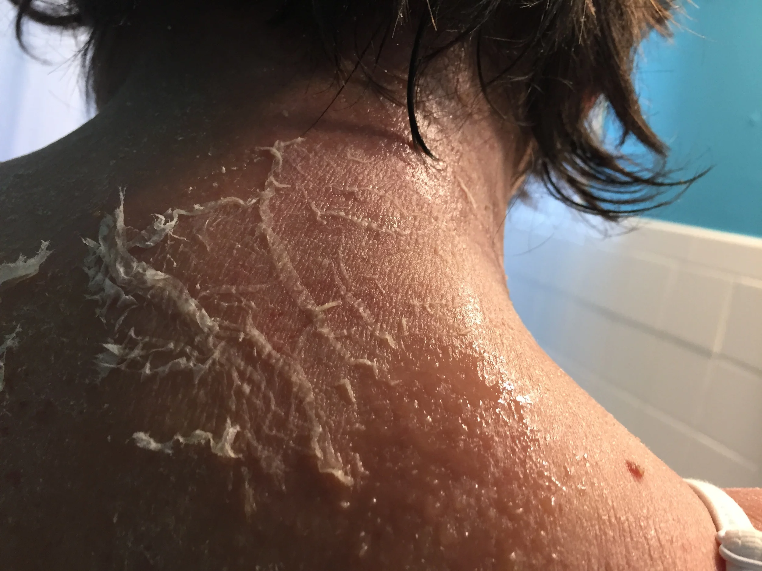 Not last night, though! I put in ear plugs and was able to sleep through most of the night without being woken up by my skin. I feel fantastic! I also started using steroid creams a bit the last few days, so I'm able to bend my elbows much more comfortably. My neck is still very raw, so it's hard to turn it to the sides, but I'm still feeling good about things. Here is a look at my neck while I was waiting to see my OBGYN this afternoon. 