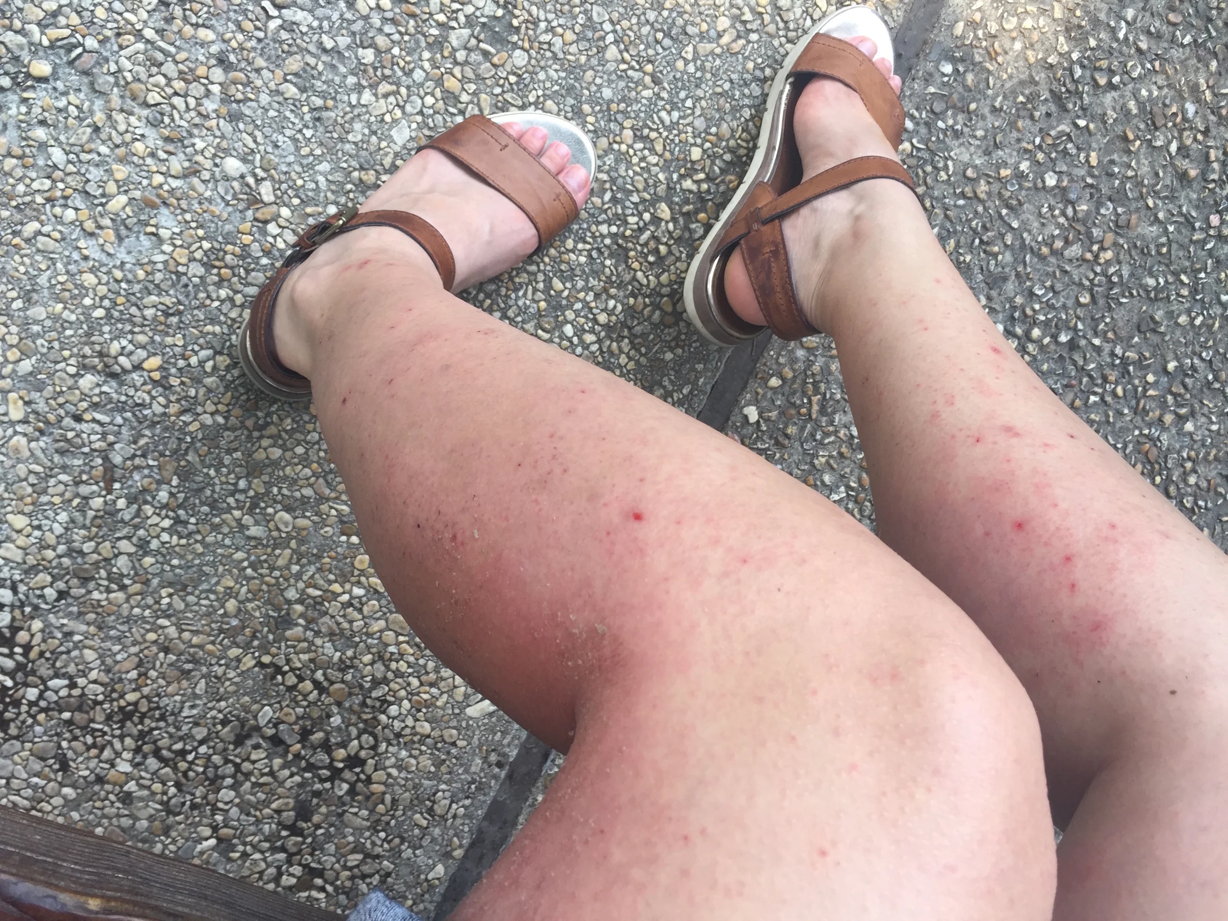 Eczema_Legs.jpg