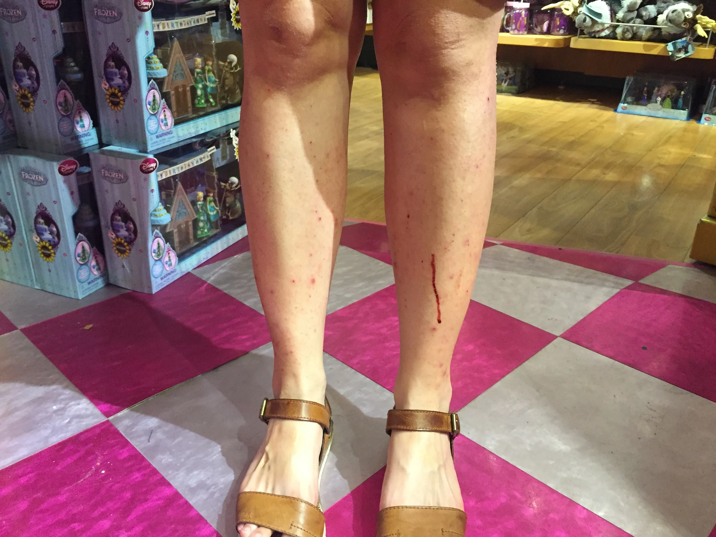 Eczema_Bleeding.jpg