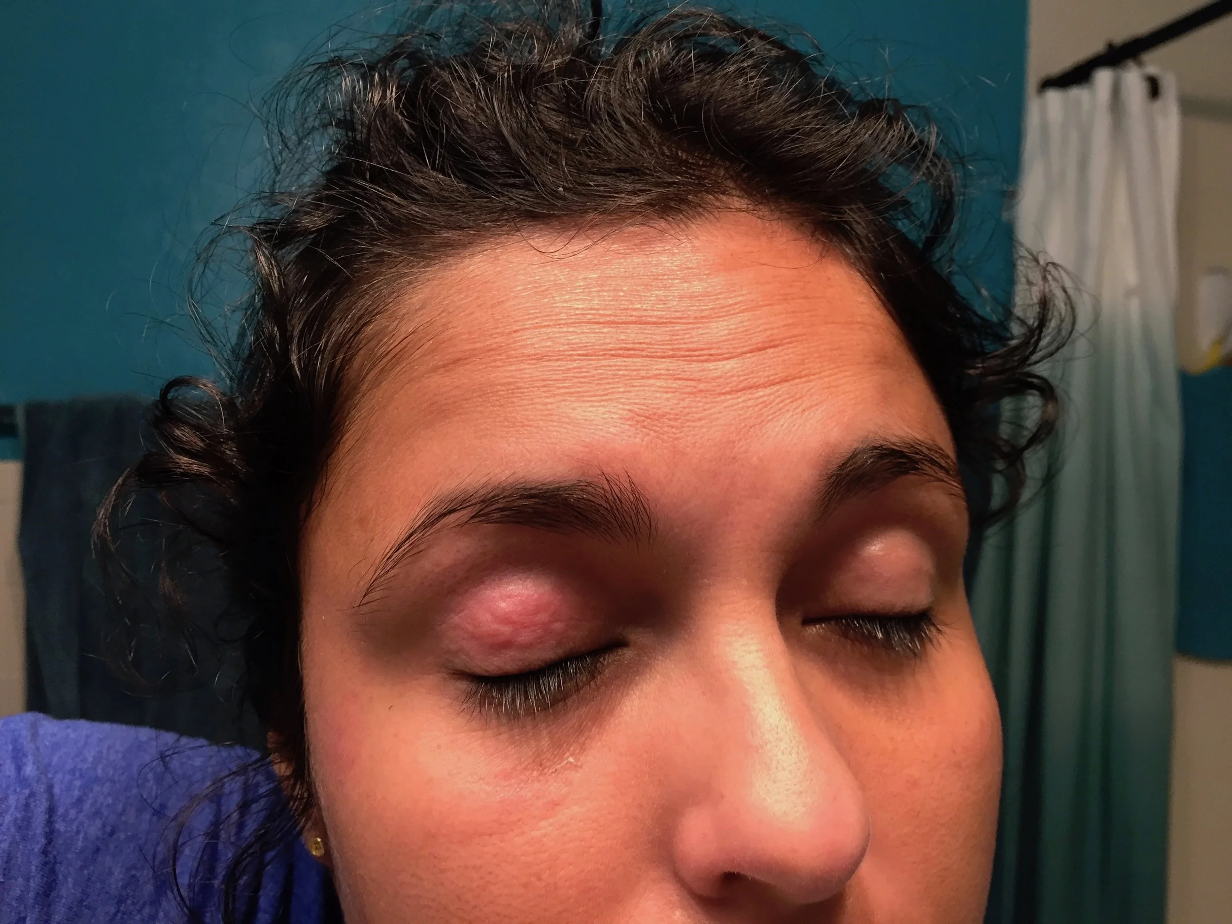 eyelid_eczema.jpg
