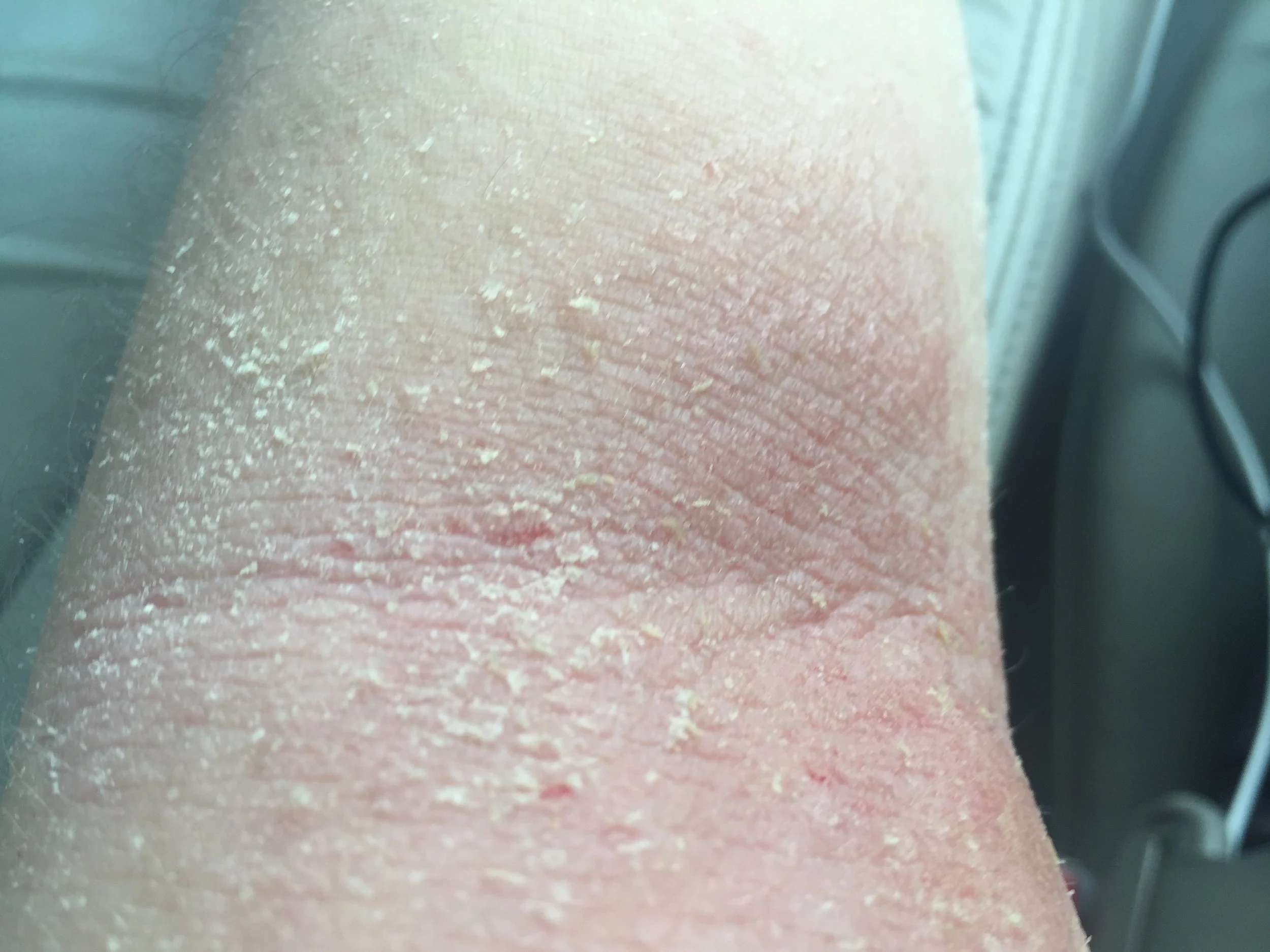 eczema_inner_elbow.jpg