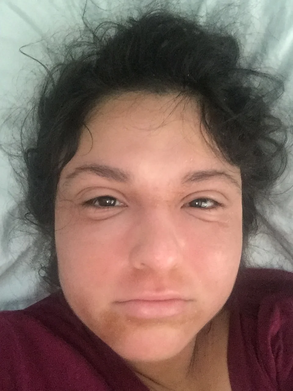 eczema_and_edema.jpg
