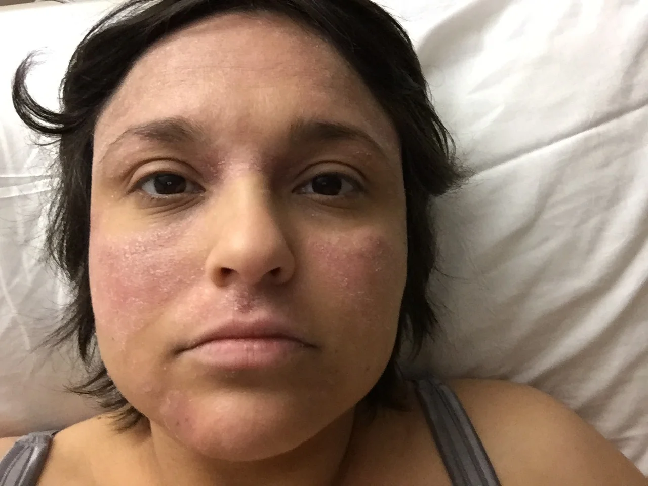 Vitamin D Eczema Reddit