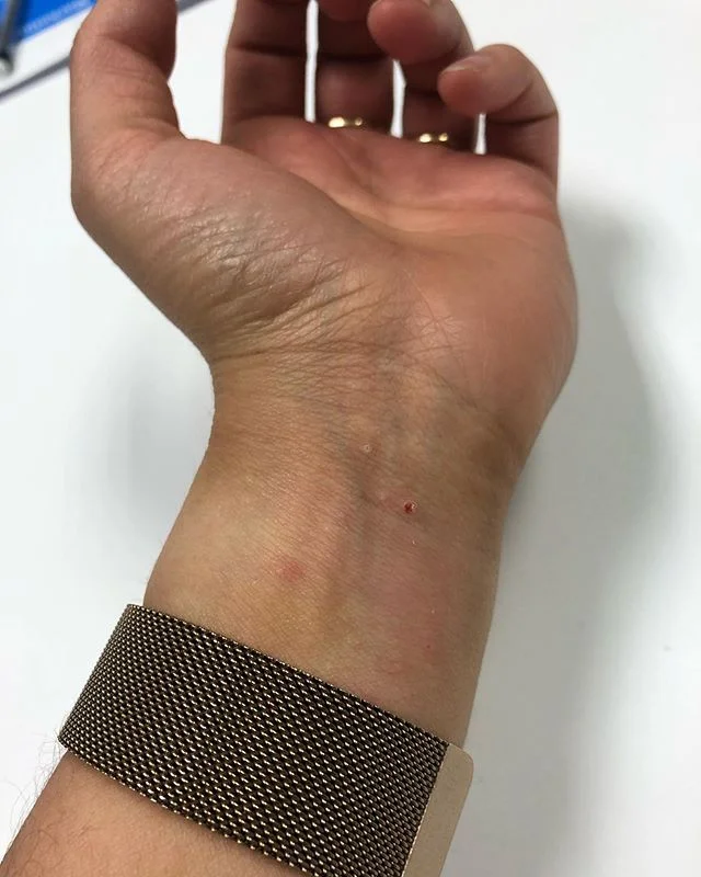 How NOT to Deal with Eczema Bleeding — Itchy Pineapple