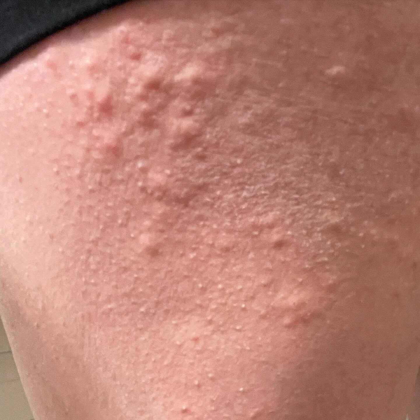 How NOT to Deal with Eczema Bleeding — Itchy Pineapple