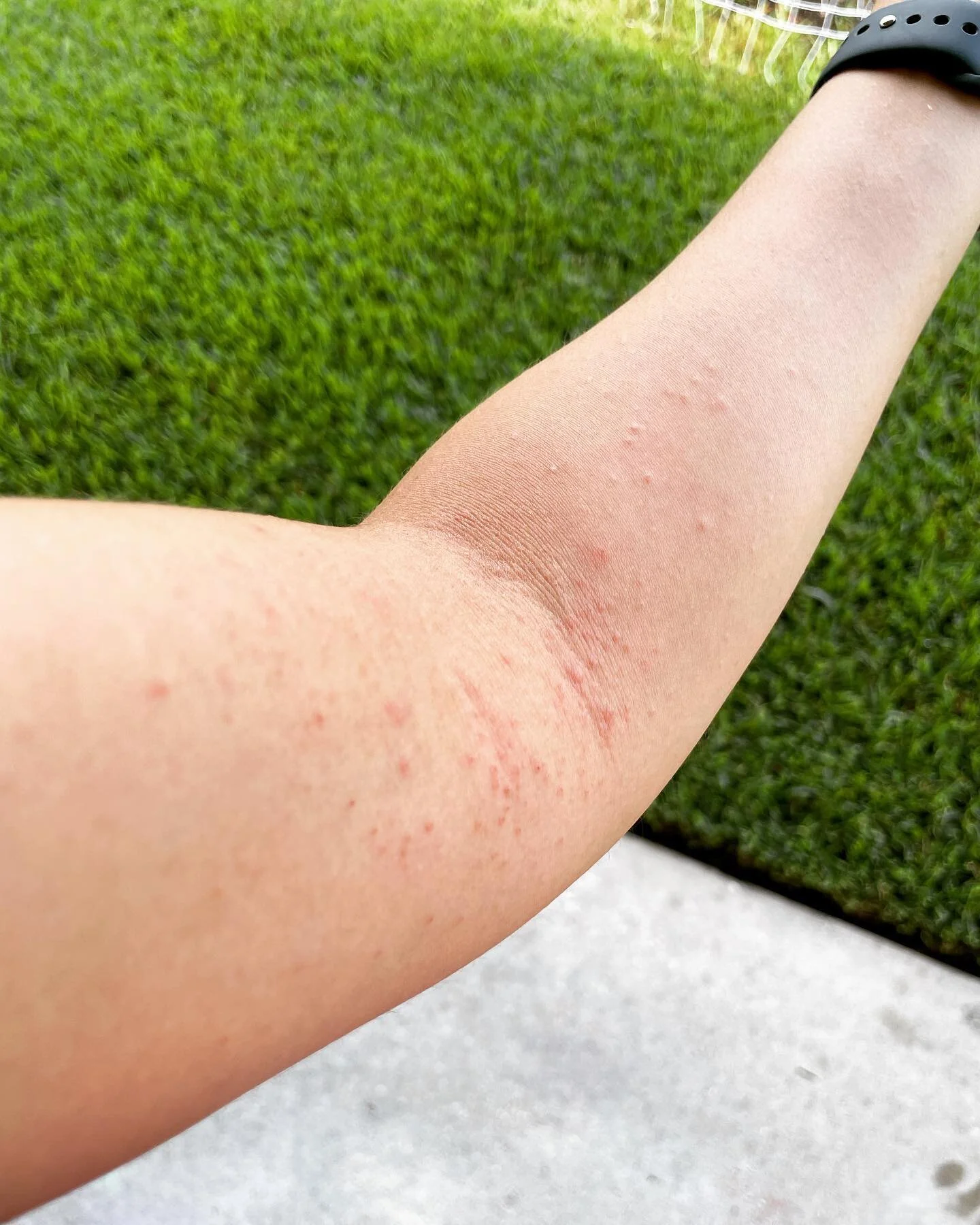 carpet-mite-bites-pictures-bios-pics