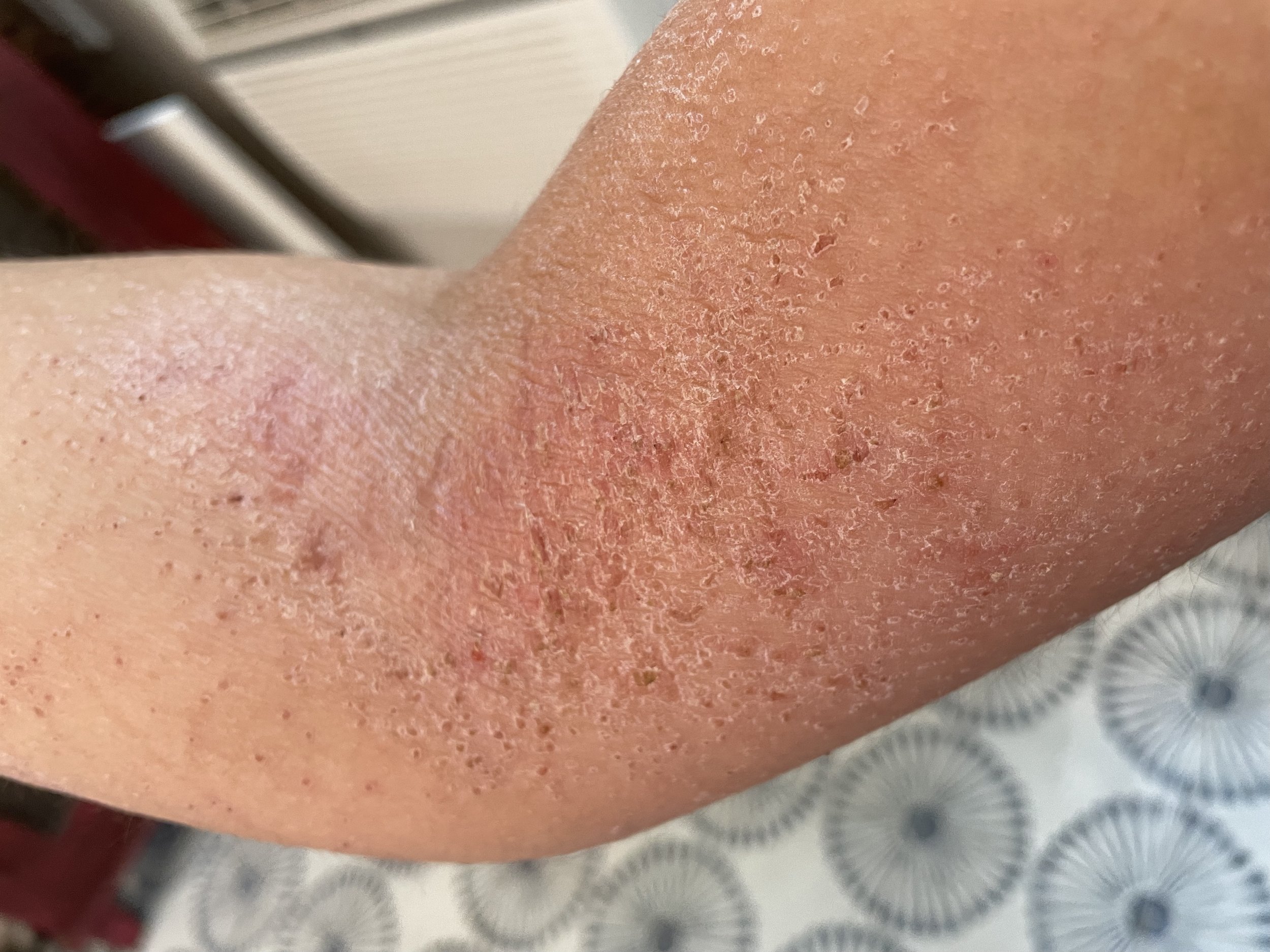 Arm_Eczema.jpg