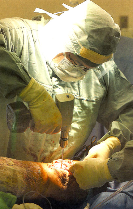 Dr. Guy Lavoie makes a few final adjustments before sewing up the skin around a knee that was once ravaged by osteoarthritis. Photo: April Bartlett/St. Albert Gazette
