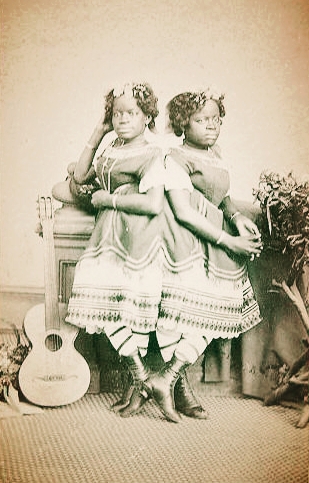 Co-joined twins, Millie McKoy and Christina McKoy