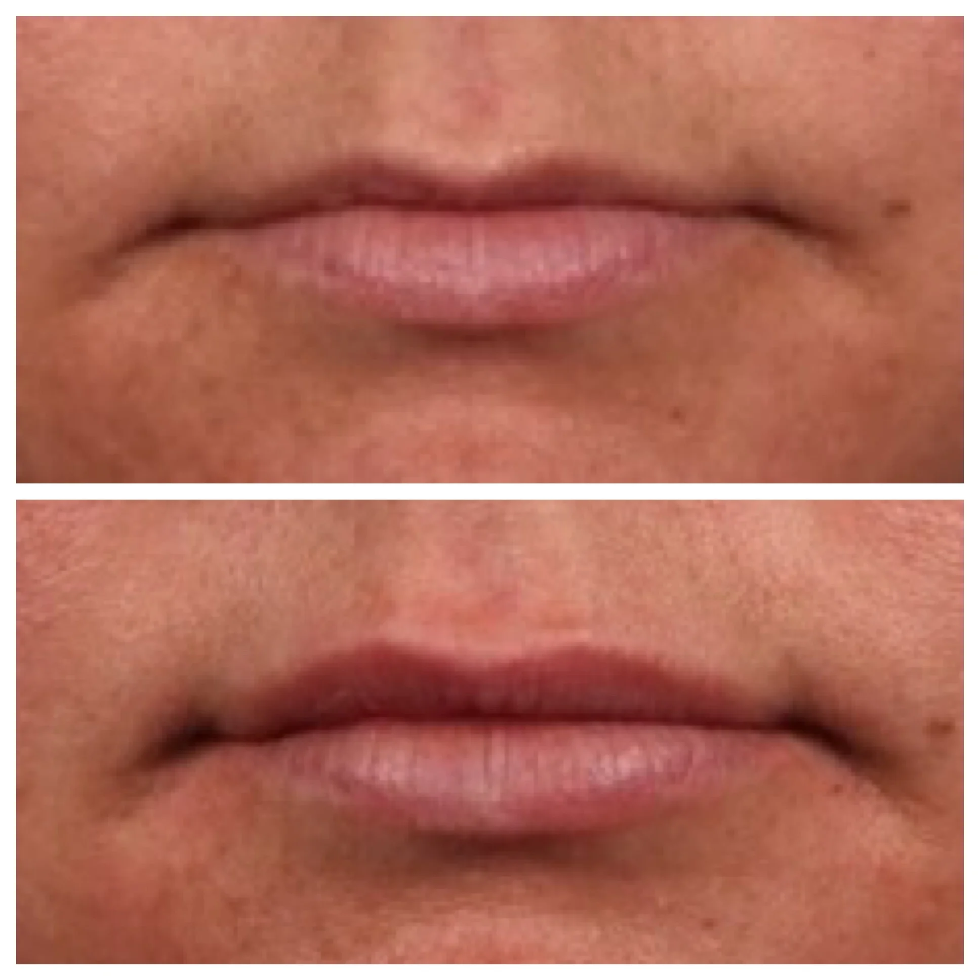 Before (top) and immediately following treatment with Volbella