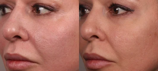 Before and one month after my PRP treatment.