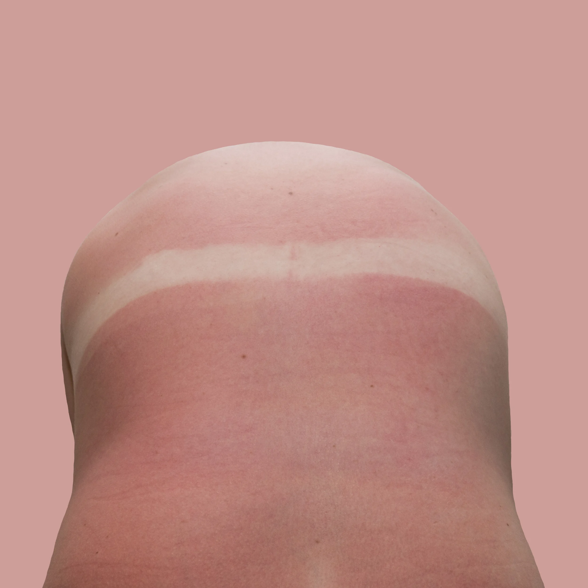Burns