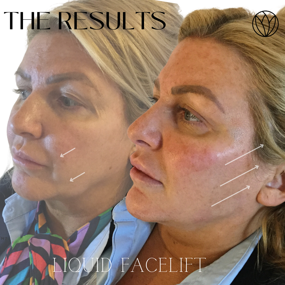 Liquid Facelift - Standard — The Skin Clinic Liquid Facelift - Standard — The Skin Clinic