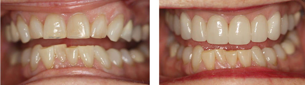 Before & After