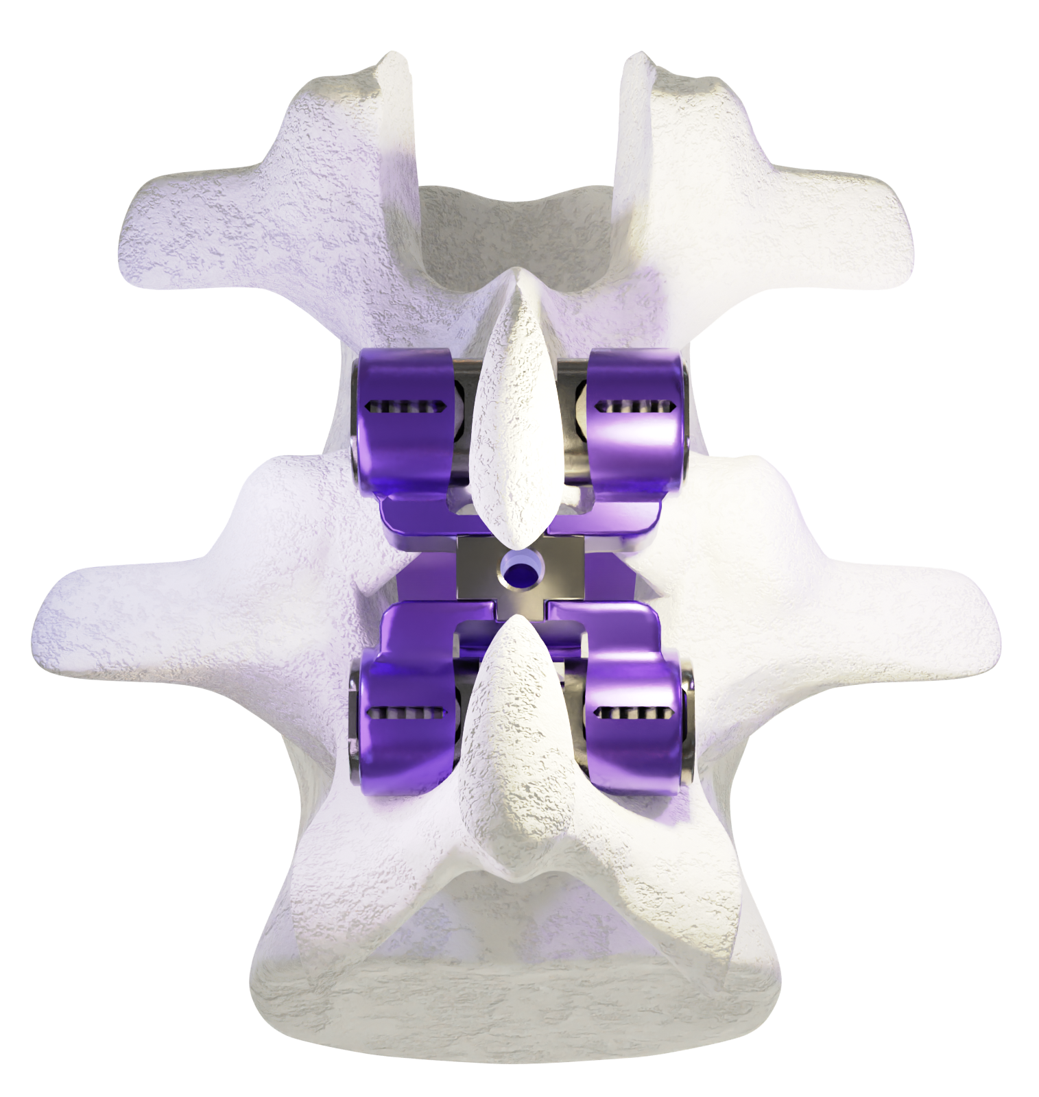 ZIPFlex — Aurora Spine