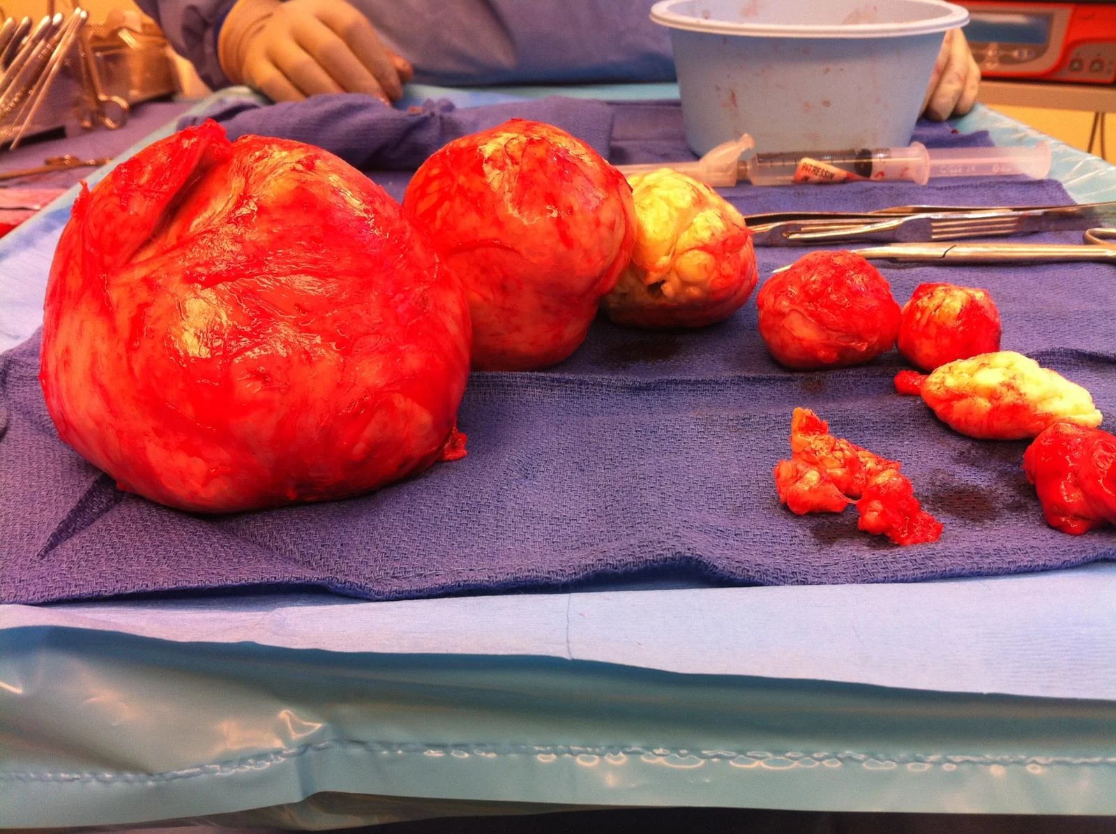 my fibroid story.