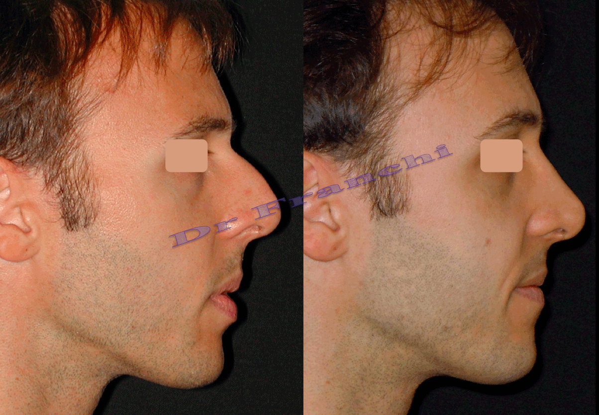 rhinoplastie-2.png