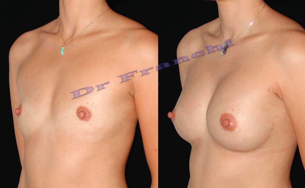 augmentation-mammaire-par-implants-3.png