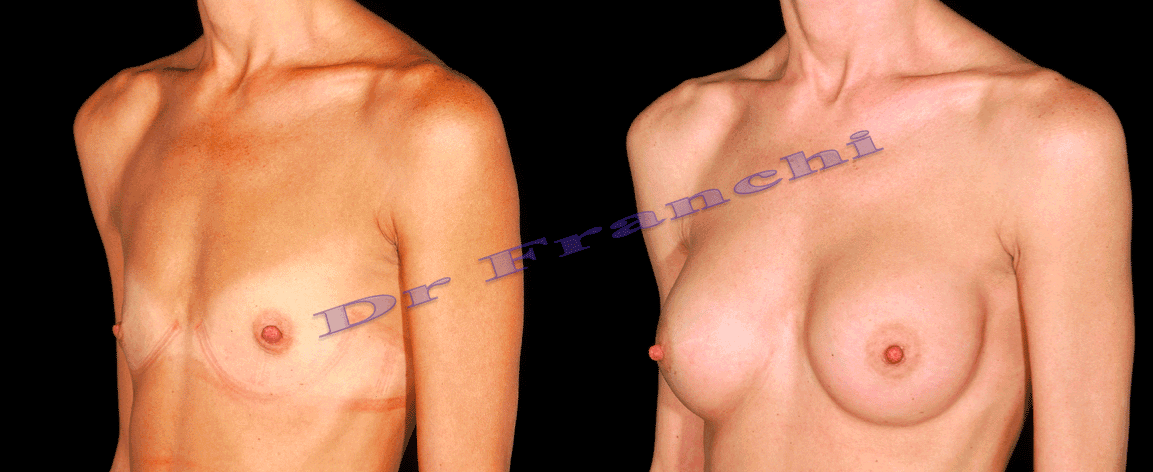 augmentation-mammaire-par-implants-7.png