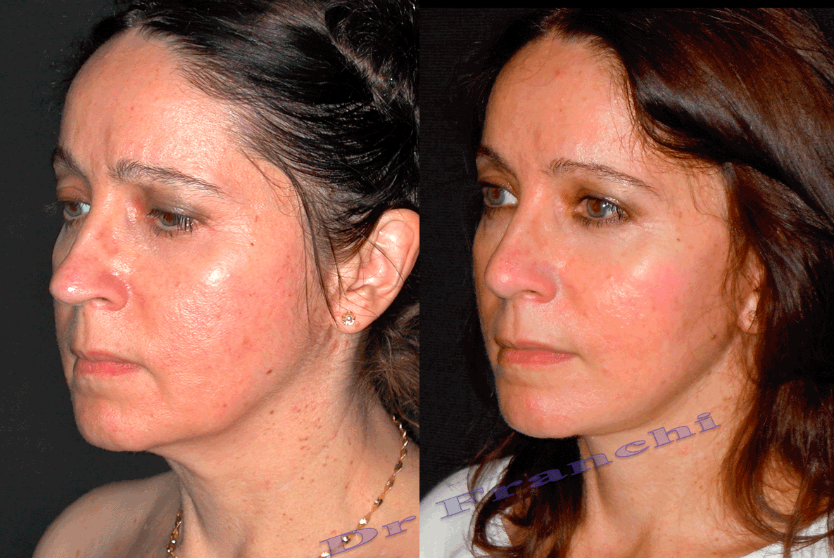 lifting-du-visage-et-du-cou-2.png
