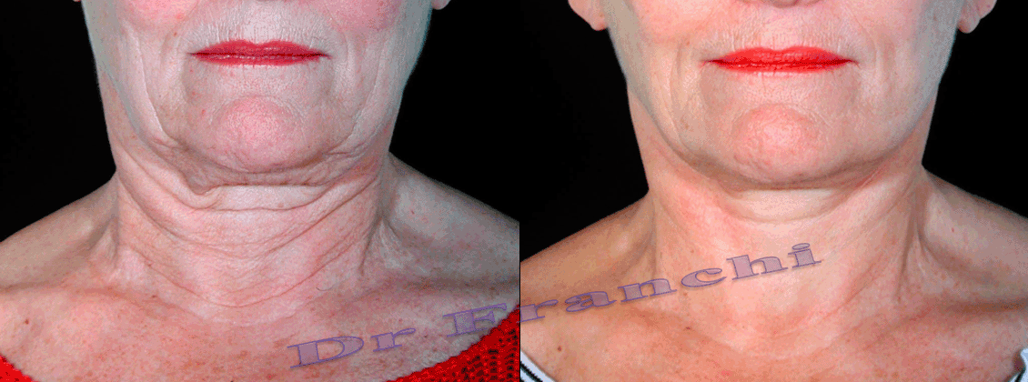 lifting-du-visage-et-du-cou-4.png