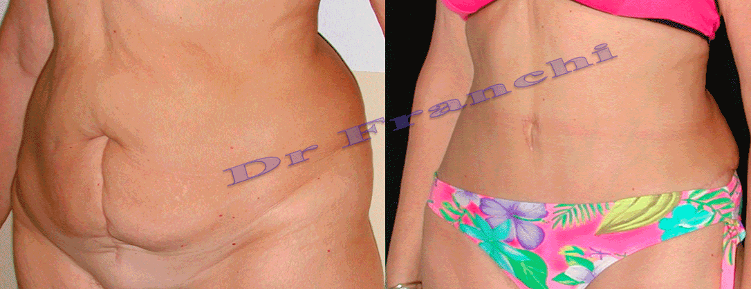 plastie-abdominale-3.png