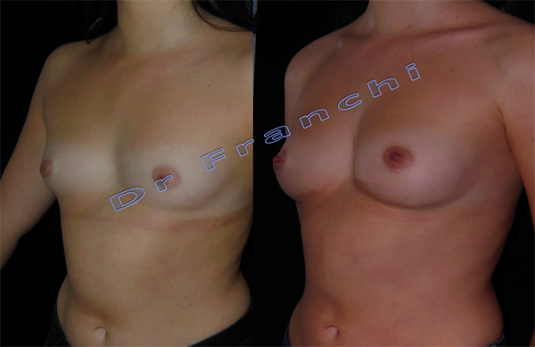 lipofilling-mammaire.png