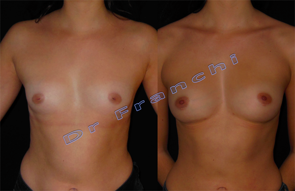 augmentation-mammaire-lipofilling.png