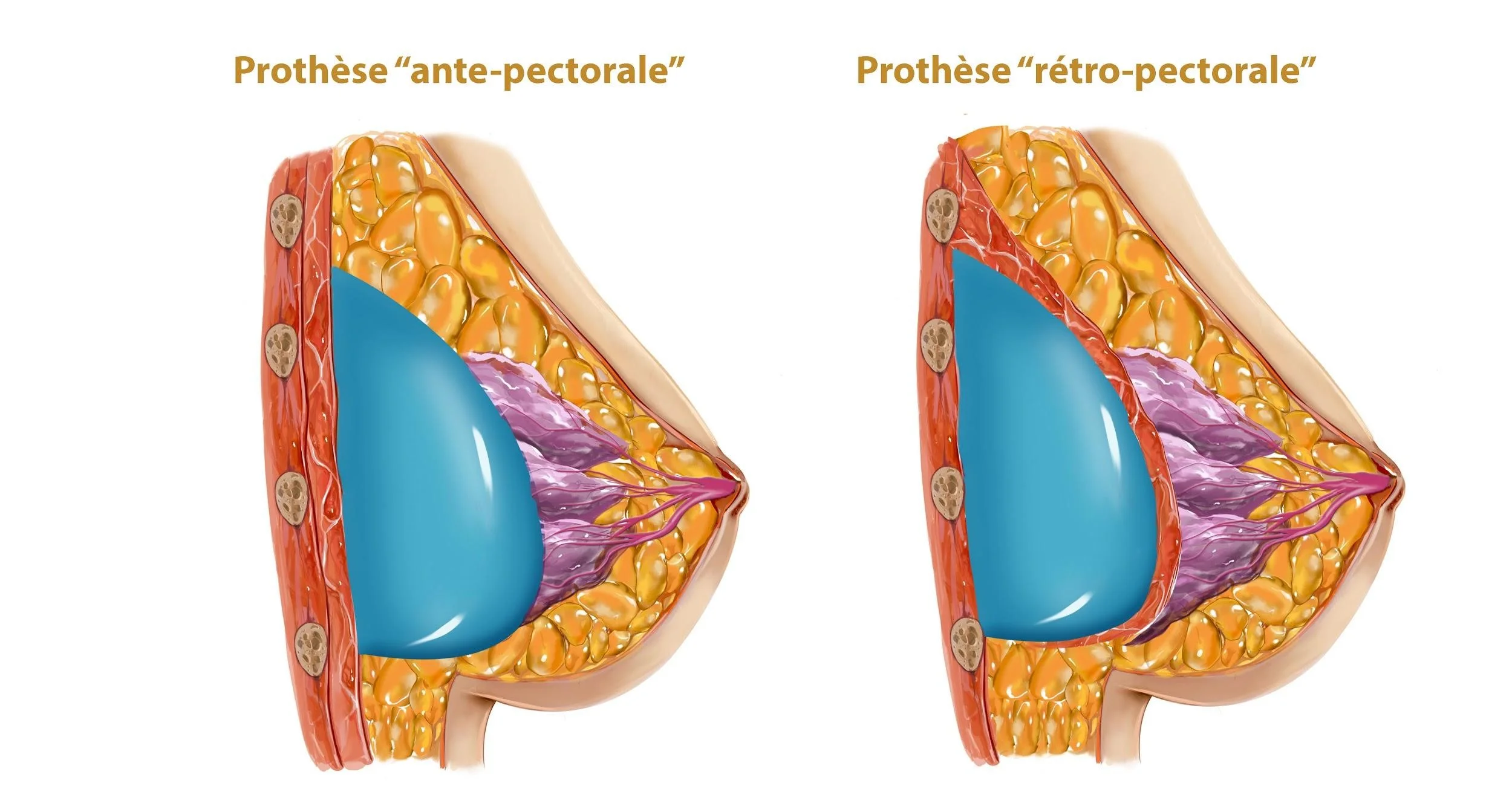 position-prothese-mammaire.jpg