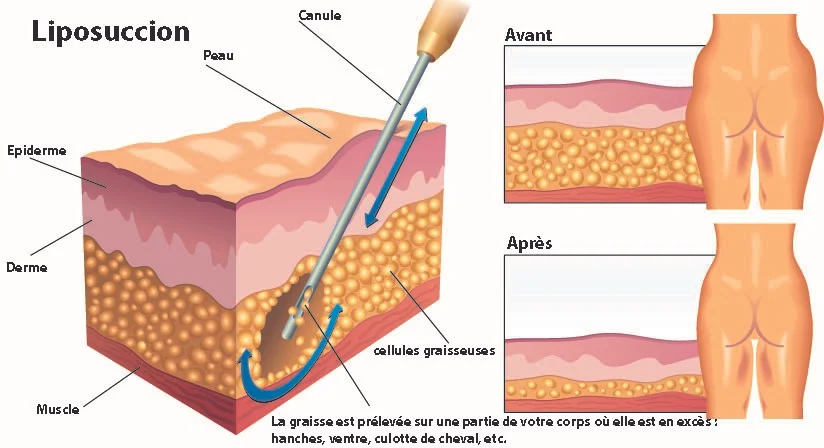 liposuccion-avant-apres.jpg