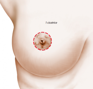 lifting-seins-cicatrice-aréolaire.png