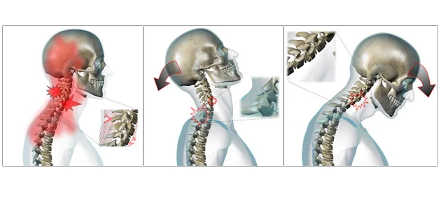 Whiplash is a series of movement with first compression forces, then hyper-extension, and then hyper-flexion. The most commonly damaged structures are ligaments. 