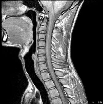 Imaging of the ligaments in the Upper Neck