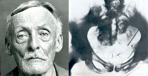  Retrato de la ficha policial de Fish y radiografía de su estómago