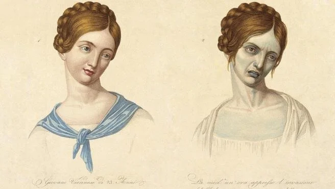 Lámina que muestra los estragos físicos de la enfermedad  azul