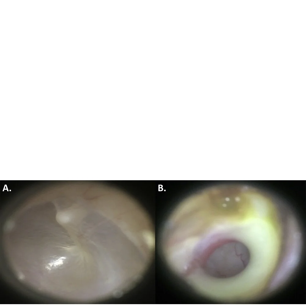 Figure 1, “Representative images of a normal (A) otoscopy and (B) abnormal otoscopy (tympanic membrane perforation with purulent effusion). Images taken via smartphone-enabled otoscope (Cellscope, San Francisco, California, USA) on an iPhone 6 (Apple, Cupertino, California, USA) using Cellscope-Oto for Clinicians software (Cellscope).” from Community health workers obtain similar results using cell-phone based hearing screening tools compared to otolaryngologists in low resourced settings .