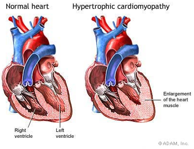 Hypertrophic+Cardiomyopathy.png