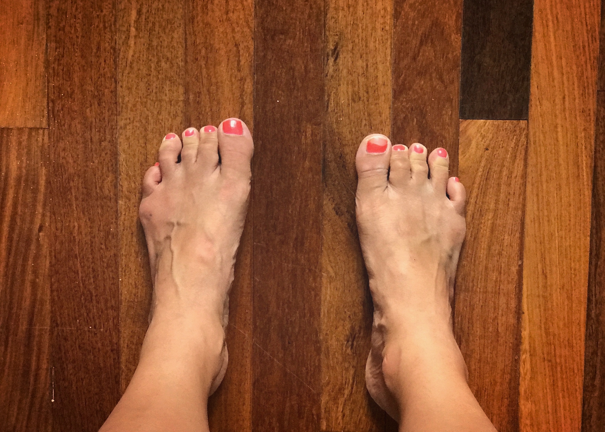 Feet overly supinated with weight on the outside edge of the foot. In this position, the heel can't properly absorb impact when walking.