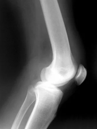 X-Ray Image of the Knee