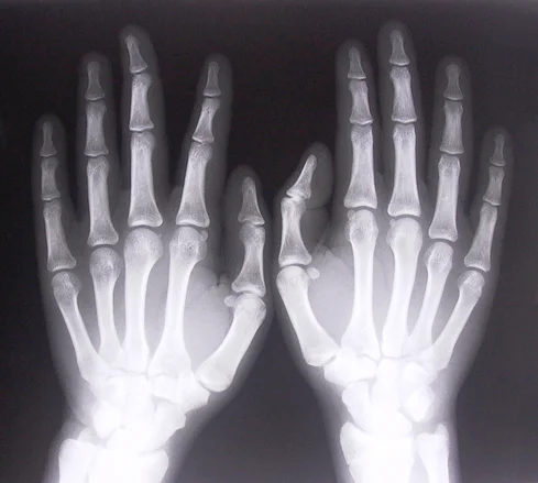 X RAY IMAGE OF THE HANDS